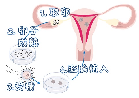 反复流产案例